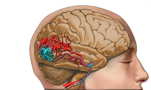  Serebrovasküler hastalıklar beyni besleyen damarların tıkanması veya kanaması ile ortaya çıkan, hasar gören beyin bölgesi ile ilgili belirtiler veren bir hastalık grubudur. 
