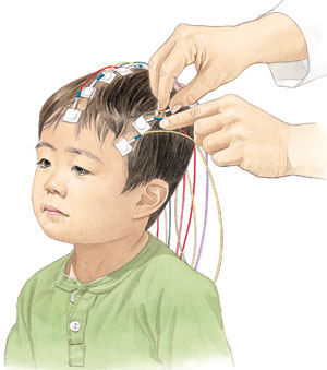  Epilepsi tanısında genel fizik ve nörolojik muayene yapıldıktan sonra başvurulacak ilk laboratuar inceleme aracı; elektroensefalografi (EEG) dir. Bu tetkik, saçlı deriye elektrotlar yapıştırılarak beyin dalgalarının kaydedildiği bir yöntemdir.  

   
