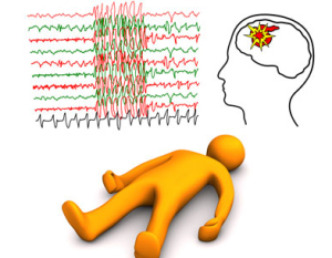  Epileptik nöbet, beyindeki hücrelerin kontrol edilemeyen, ani, aşırı ve anormal deşarjlarına bağlı olarak ortaya çıkan bir durumdur. Epilepsi, halk arasında “Sar’a hastalığı” olarak bilinir 
